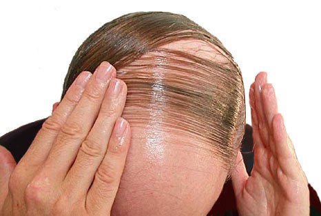  cure your baldness